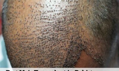 Best Hair Transplant in Pakistan