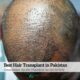Best Hair Transplant in Pakistan