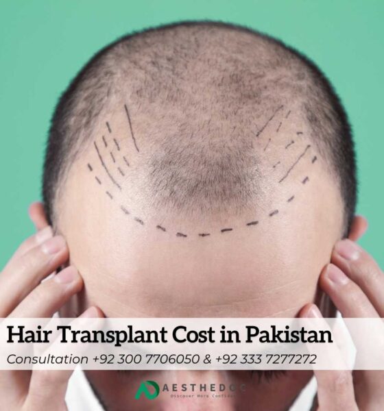 Hair Transplant Cost in Pakistan