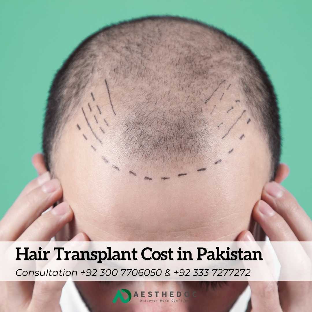 Hair Transplant Cost in Pakistan