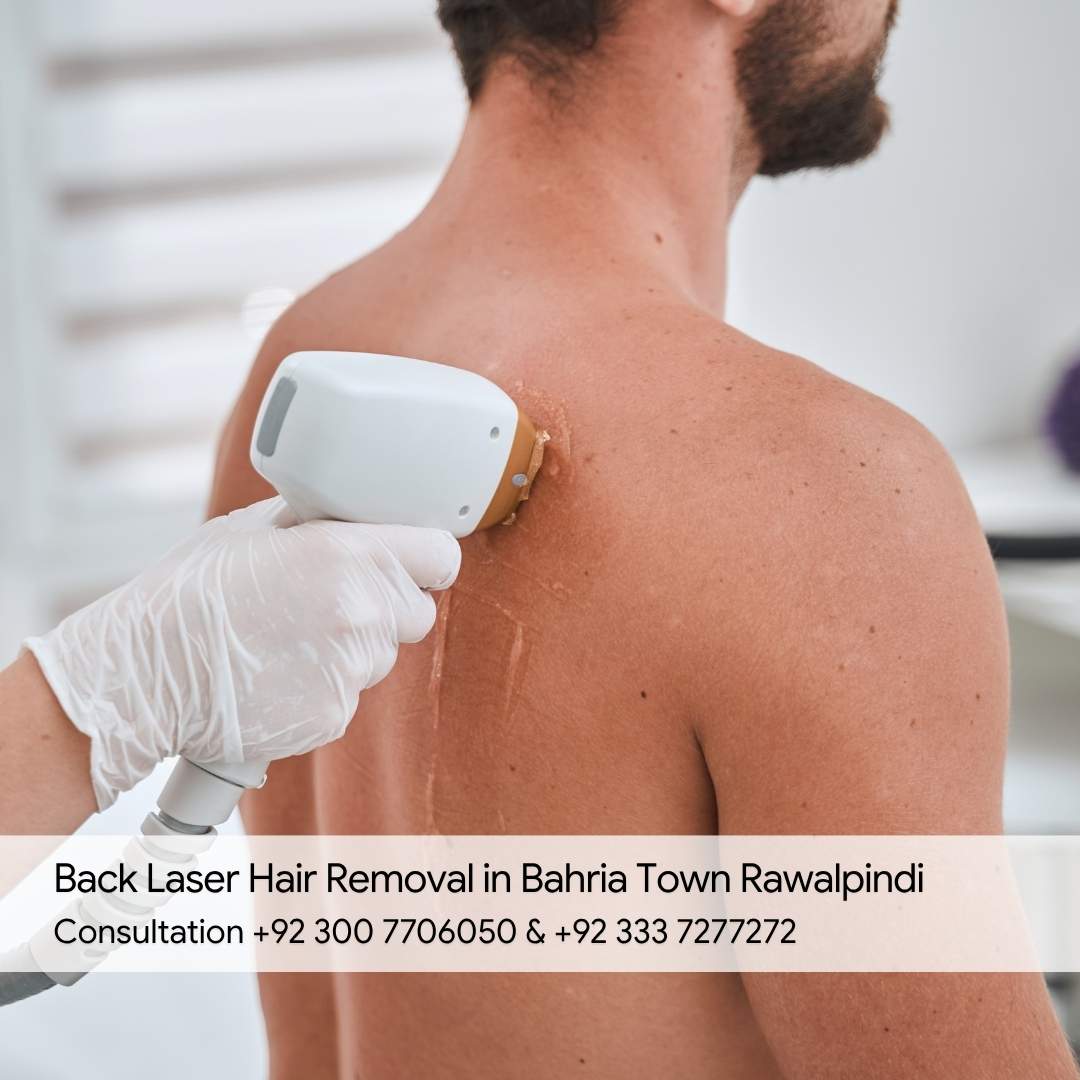 Back Laser Hair Removal in Bahria Town Rawalpindi